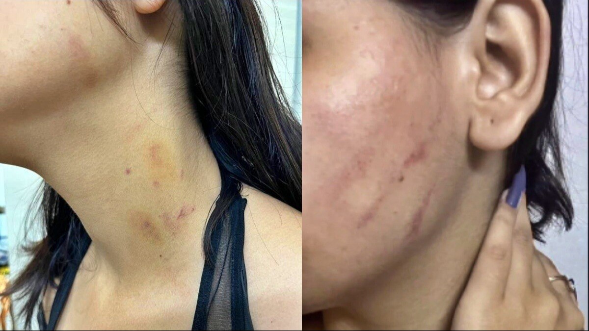 नोएडा: चोट के निशान दिखाती युवती 