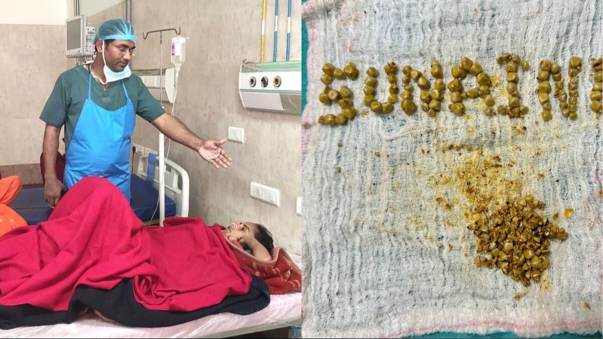  निकाले गए स्टोन.