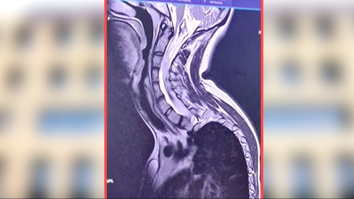 AIIMS भोपाल में हुआ दुनिया के सबसे लंबे स्पाइनल ट्यूमर का ऑपरेशन.