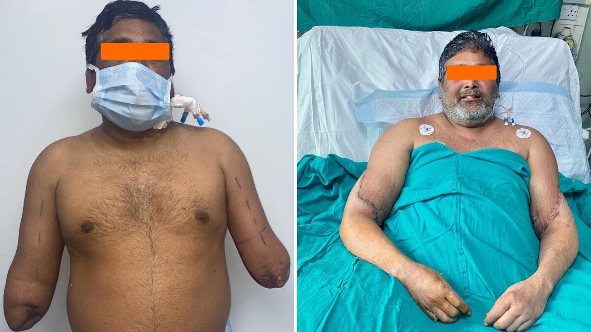 ट्रेन हादसे में दोनो हांथ गंवा चुके शख्स सर्जरी के बाद मिली नई जिंदगी