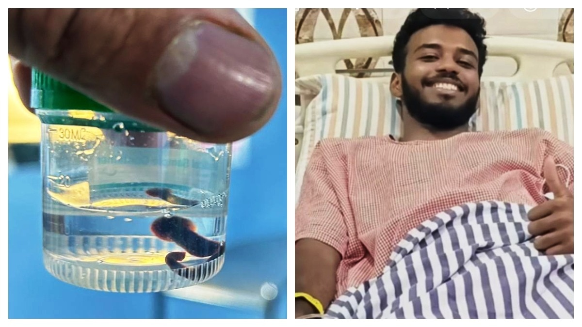 डॉक्टरों ने ऑपरेशन कर कीड़े को नाक से निकाला