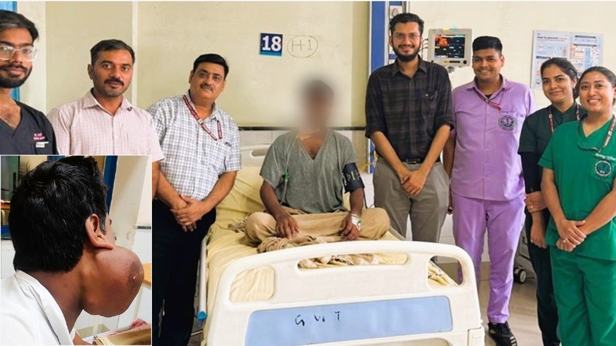 डॉक्टरों की टीम ने मरीज के चेहरे से निकाला ट्यूमर.