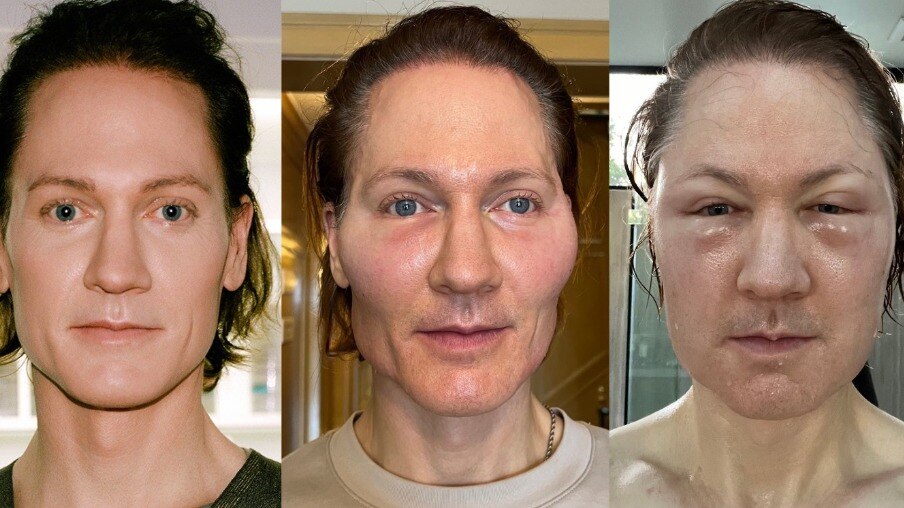 जवान दिखने की चाहत... पहले बेटे का खून खुद को चढ़ाया, फिर चेहरे में इंजेक्ट कराया फैट