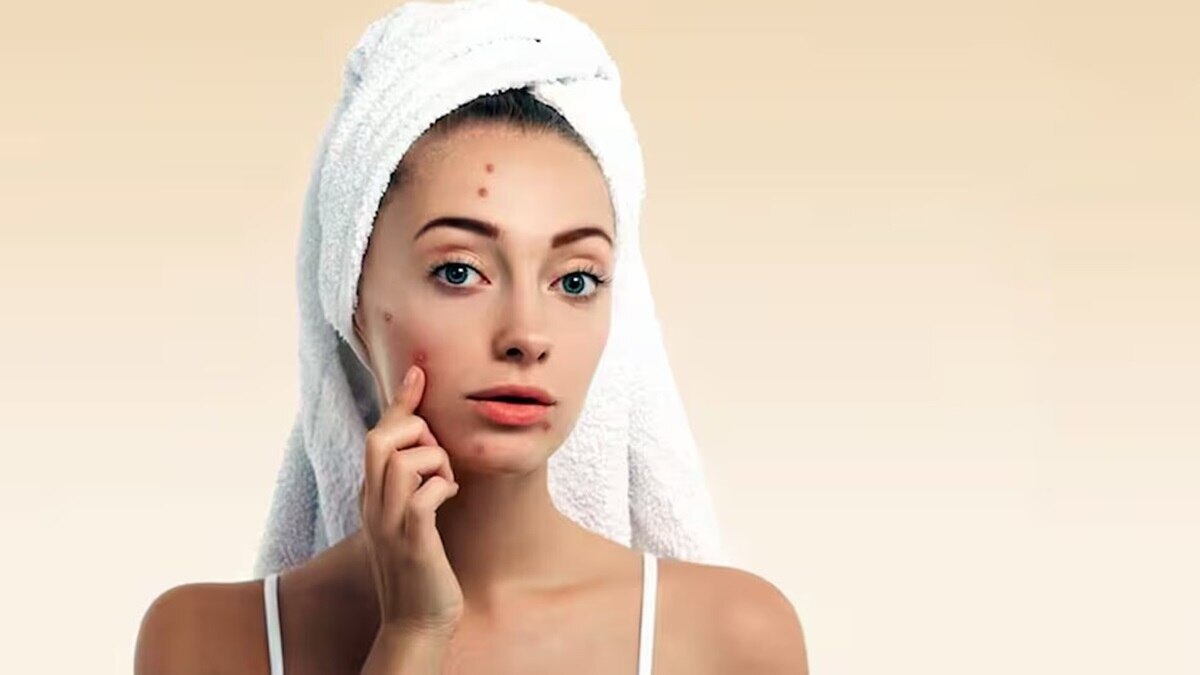 हार्मोनल एक्ने को कैसे कर सकते हैं कंट्रोल