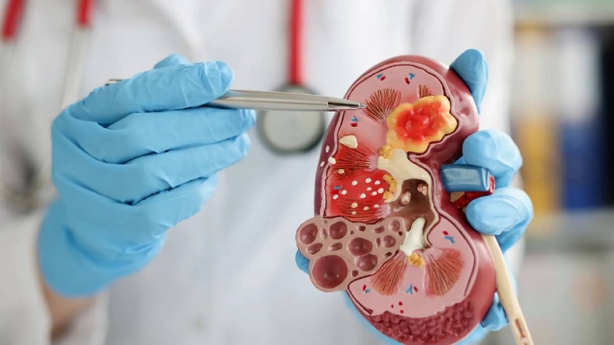 Kidney's Health: क्या एक किडनी के साथ जीना होता है मुश्किल? यहां जानिए सबकुछ