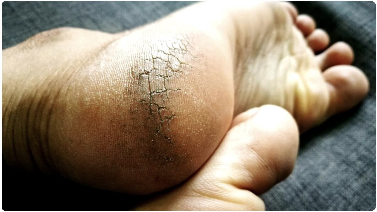 गर्मी में भी एड़ियां फट जाती हैं.