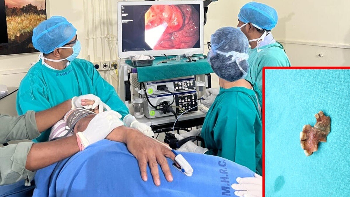 भूल से निगल गया नकली दांत तो आहार नली में जा फंसे, खाना और बोलना तक हुआ मुश्किल, डॉक्टरों ने बिना सर्जरी बाहर निकाले