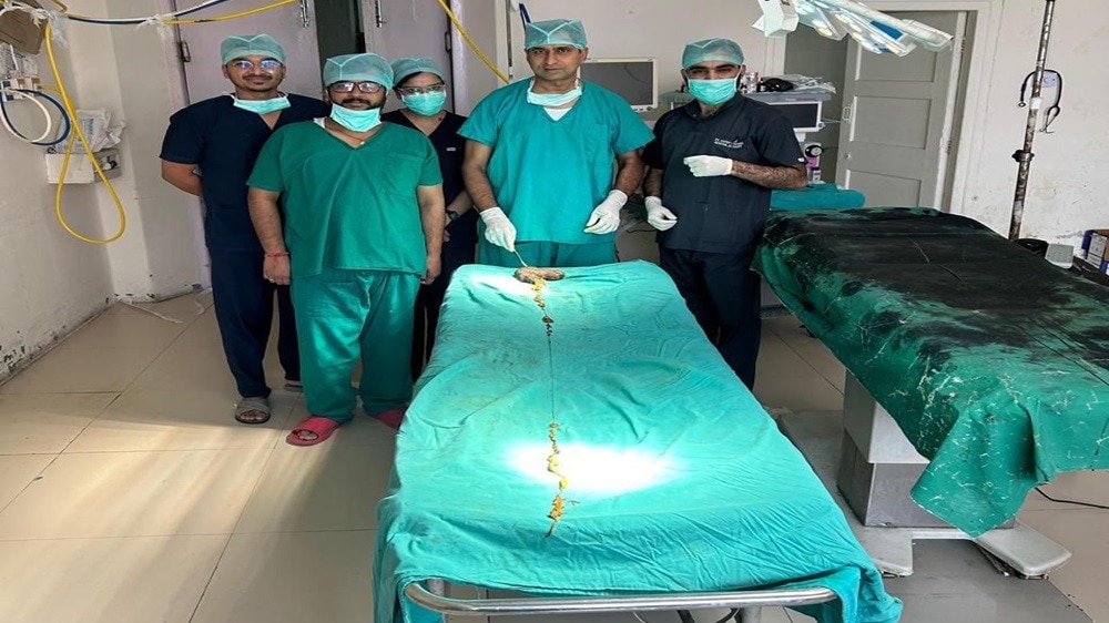 सर्जरी कर डॉक्टरों ने निकाला दुनिया का सबसे लंबा ट्राइकोबेज़ोअर
