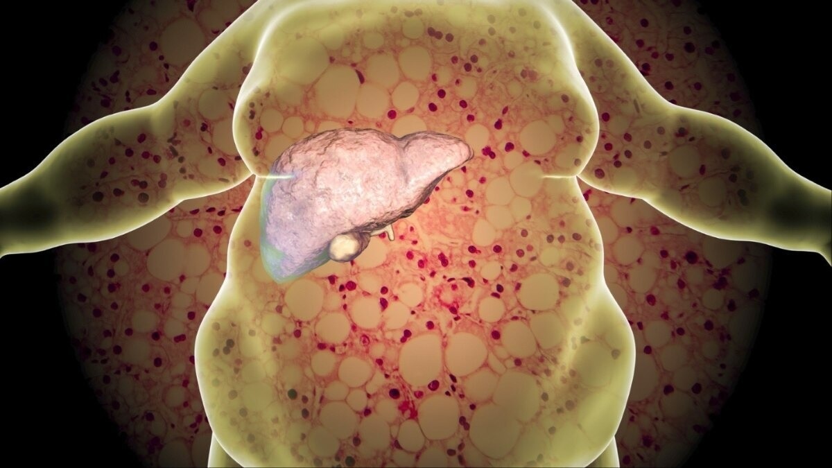 फैटी लिवर 