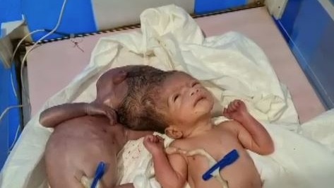 मधेपुरा में जन्मे सिर से जुड़े जुड़वां बच्चे