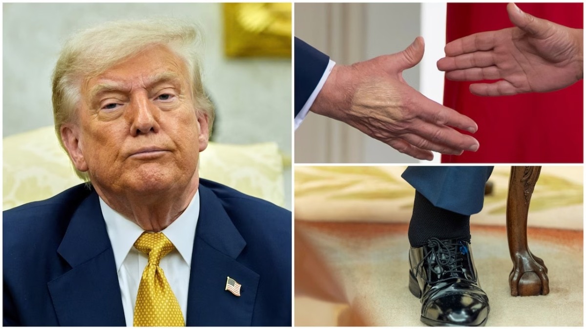 राष्ट्रपति ट्रंप क्रॉनिक वेनस इनसफिशियंसी बीमारी से जूझ रहे हैं. (Photo: AP)