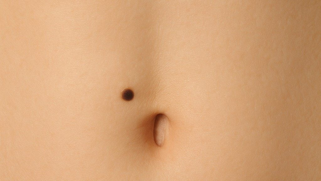 mole on navel