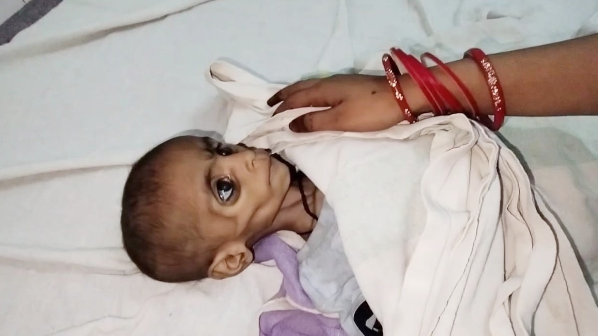 शिवपुरी में कुपोषण से बच्ची की मौत.