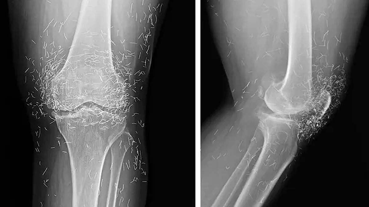 महिला के एक्सरे में उसके घुटनों के आसपास सोने के तार दिख रहे हैं. (Photo: The New England Journal of Medicine)