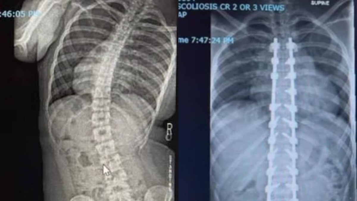 स्कोलियो  इसमें रीढ़ साइड में S या C शेप में मुड़ जाती है (PHOTO:Reddit/r/MadeMeSmile)