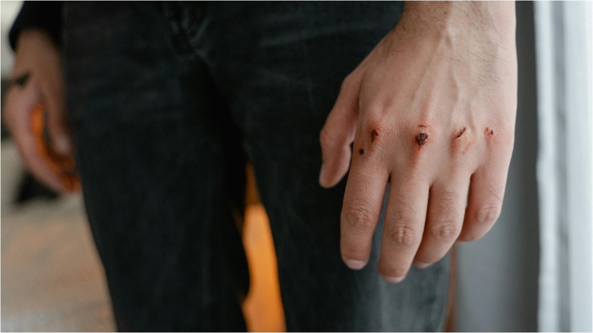 चोर ने दुकानदार को काटा, इंसान के काटने से हुआ ऐसा इंफेक्शन कि डॉक्टर भी रह गए हैरान