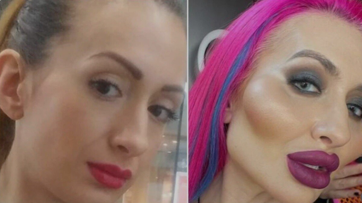 सबसे बड़े गालों के चक्कर में मॉडल ने बनाया अपना ऐसा हुलिया! करवा चुकी हैं कई सर्जरी