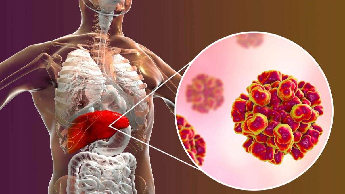 NAFLD. (Photo: Getty)