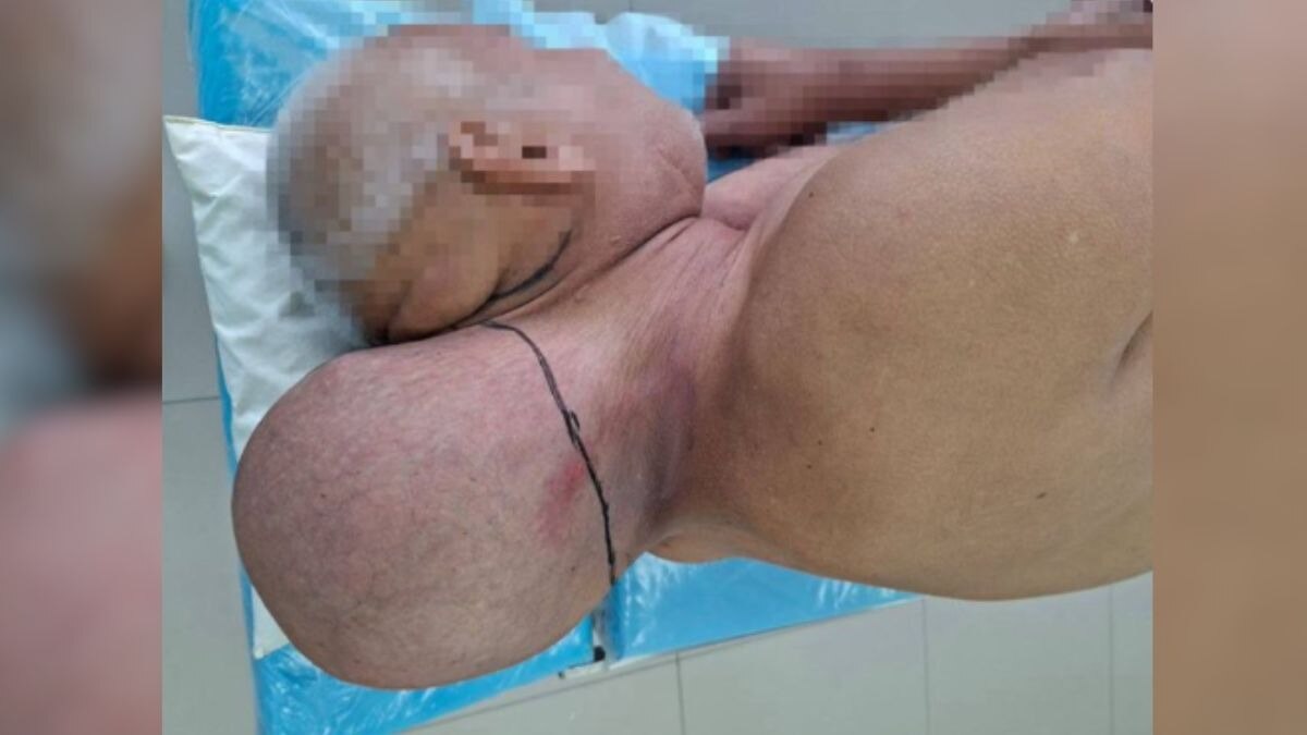 जैसे दो सिर हों... 16 साल से शख्स के गर्दन पर था ट्यूमर, फिर...