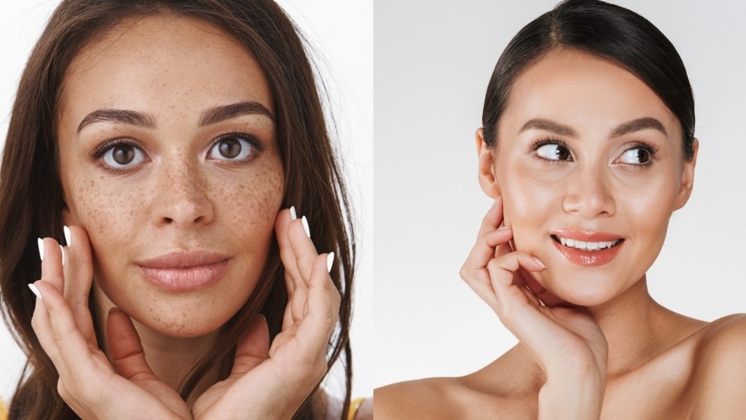 pigmentation and dark circles face