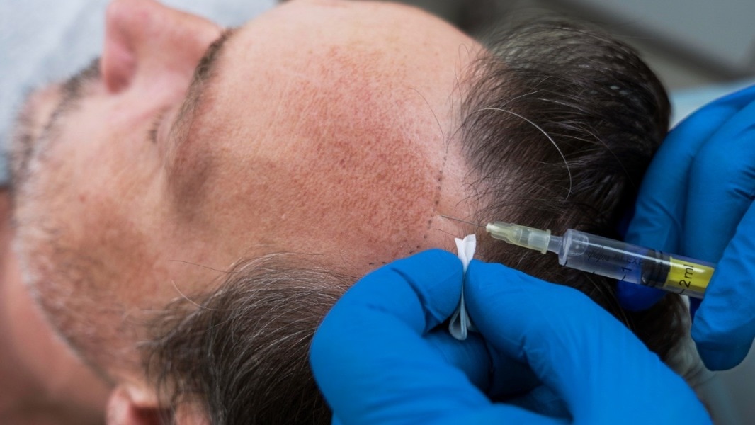 Hair Transplant Recovery