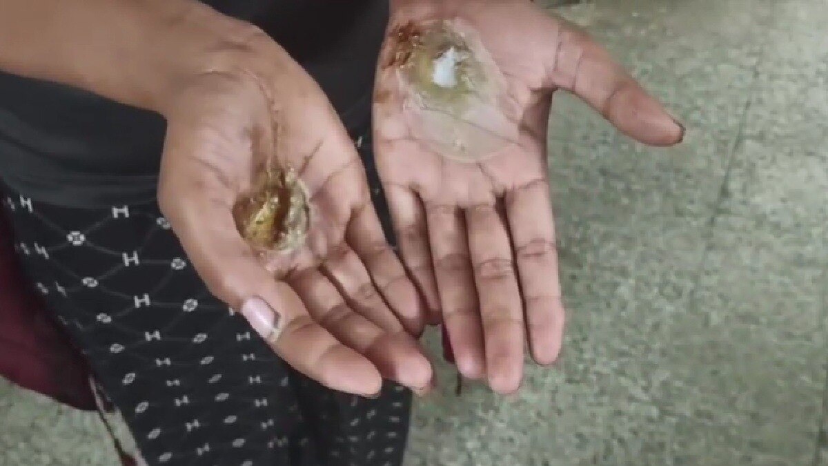 बांधकर जलाई हथेली, बेटी के साथ माता पिता की बेरहमी (Photo: ITG)