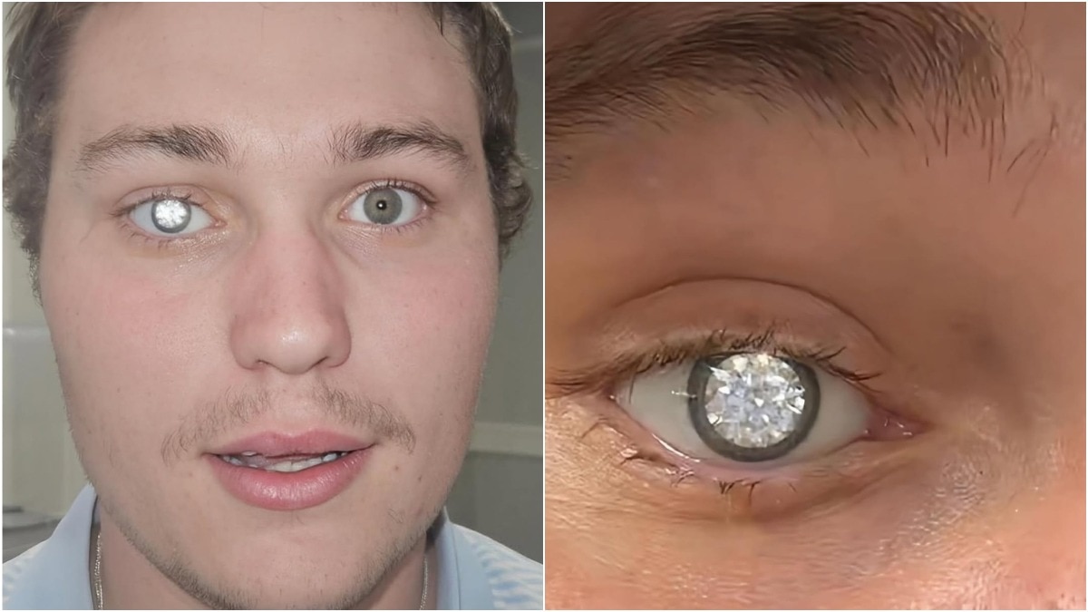 अलबामा के एक शख्स ने हीरे की बनवाई नकली आंख (Photo - Instagram/@ driptriangle )
