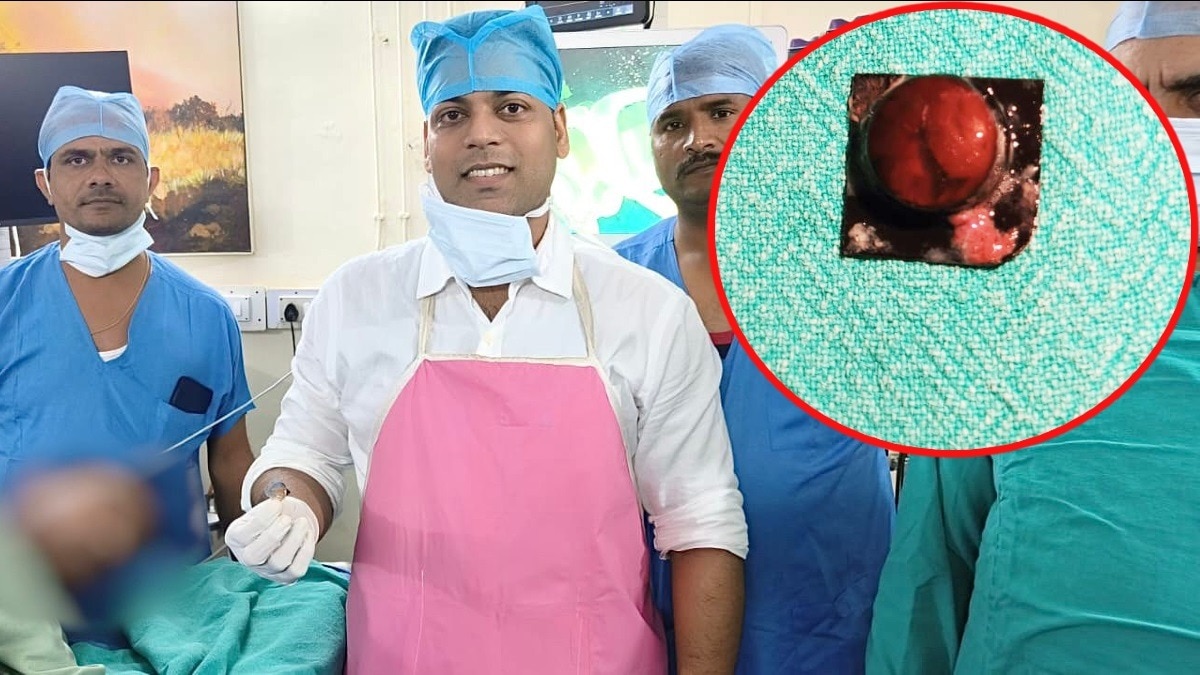 मरीज ने दवा के संग निगल लिया नुकीला रैपर, भीतरी परत पर बने घाव, इलाज न मिलता तो फट सकती थी आहार नली