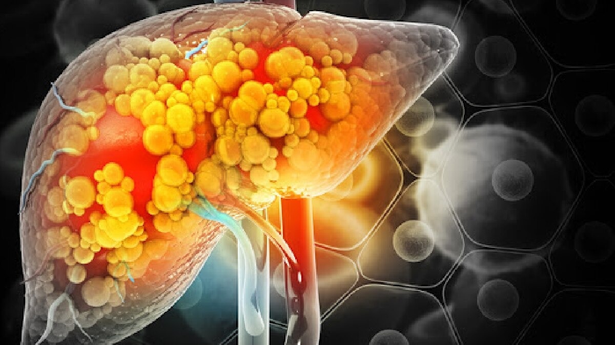 फैटी लिवर कम उम्र के लोगों को भी हो रहा है. (Photo: Ai Generated)