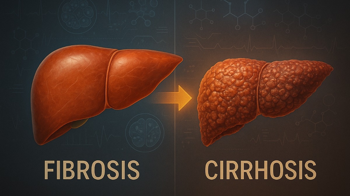 liver-fibrosis-vs-cirrhosis