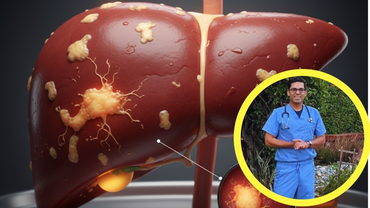 फैटी लिवर को कम करने के लिए पिएं ये ड्रिंक्स (Photo: AI generated/Instagram@doctor.sethi)