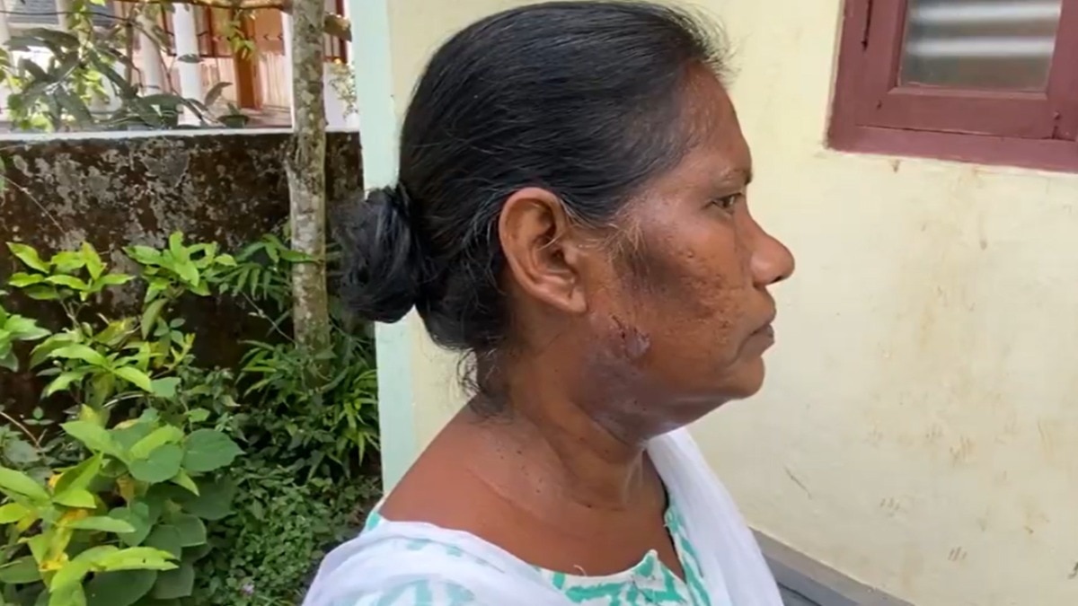 केरल में SIR फॉर्म देने गई BLO पर कुत्ते से करवा दिया हमला, चेहरे और गर्दन पर आईं चोट