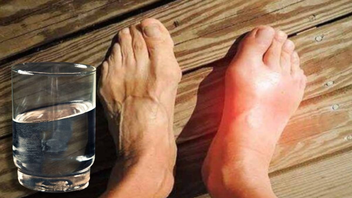 यूरिक एसिड कम करने के लिए कितना पानी पीना चाहिए? जान लें सही मात्रा