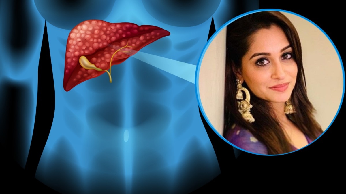 लिवर का 22% हिस्सा निकाला…फिर भी कैसे सर्वाइव कर रहा दीपिका कक्कड़ का शरीर? जवाब है हैरान करने वाला