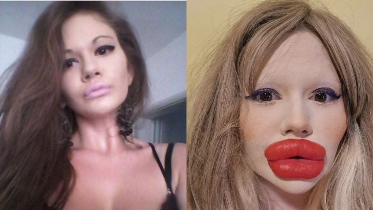 लिप फिलर से चाहा था ग्लैमरस लुक, लेकिन होंठ फूले इतने कि डॉक्टरों ने हाथ खड़े कर दिए