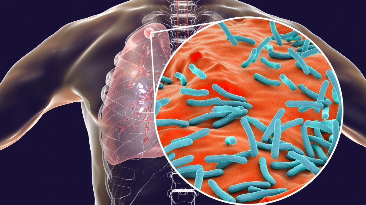 Cases of asthma, bronchitis and COPD have increased due to rise in air pollution. (Photo courtesy: Getty)