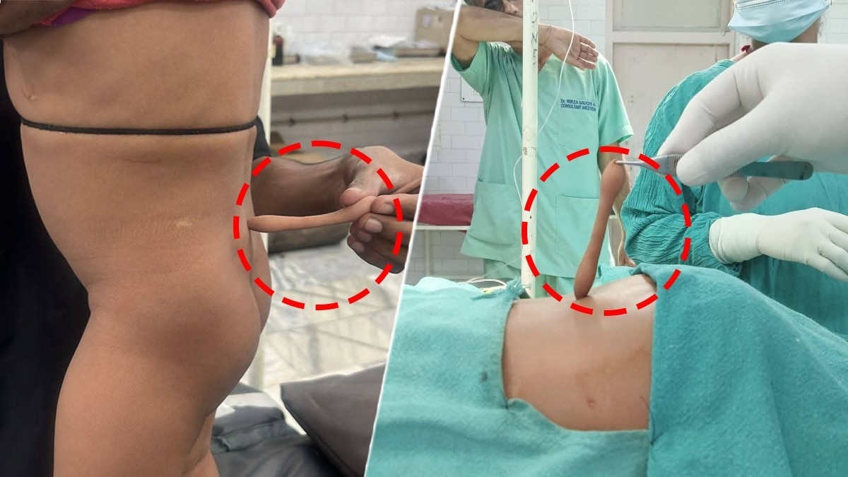 डॉक्टरों ने ऑपरेशन करके पूंछ को अलग कर दिया (Photo: ITG)