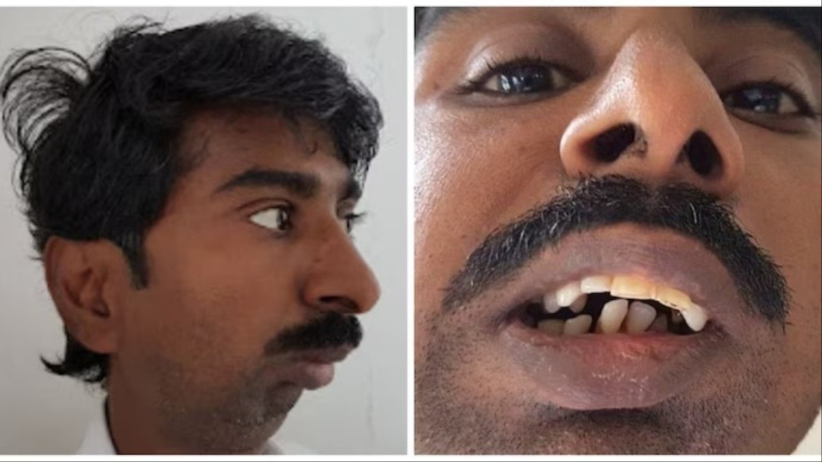 टूटे जबड़े की फोटो, नफरती कमेंट... भारतीयों के खिलाफ अमेरिका में हेट की हद हो गई!