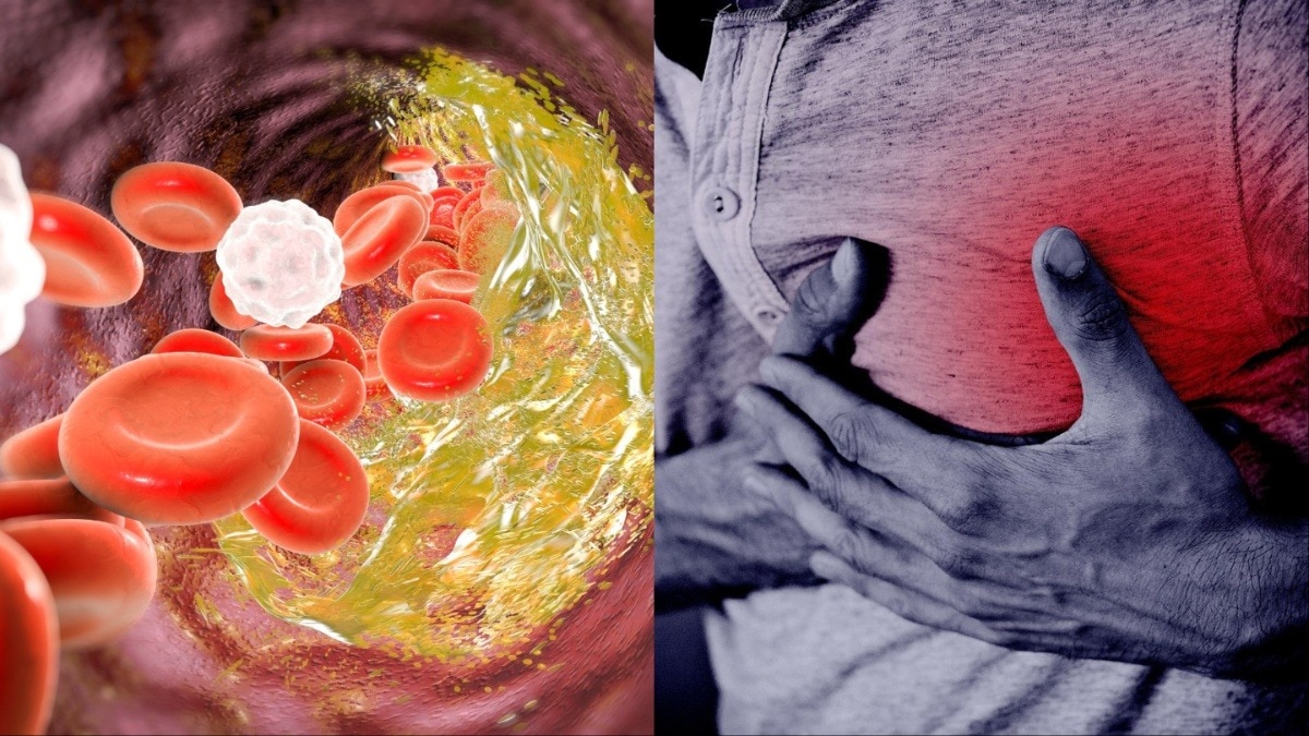 Natural Remedy to Lower Bad Cholesterol 