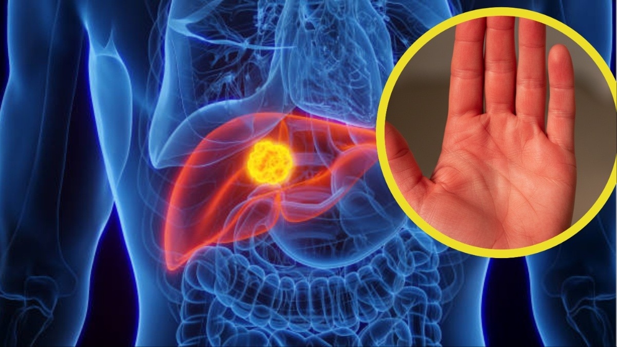 Signs of Liver damage in hands