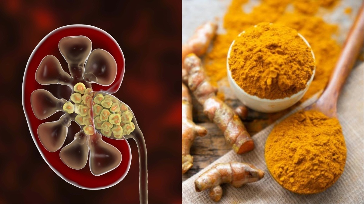 Natural Herbs for Fatty Liver