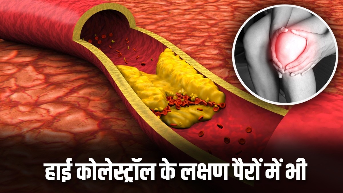 हाई कोलेस्ट्रॉल से हार्ट की बीमारियों को जोखिम बढ़ जाता है. (Photo: Pixabay)