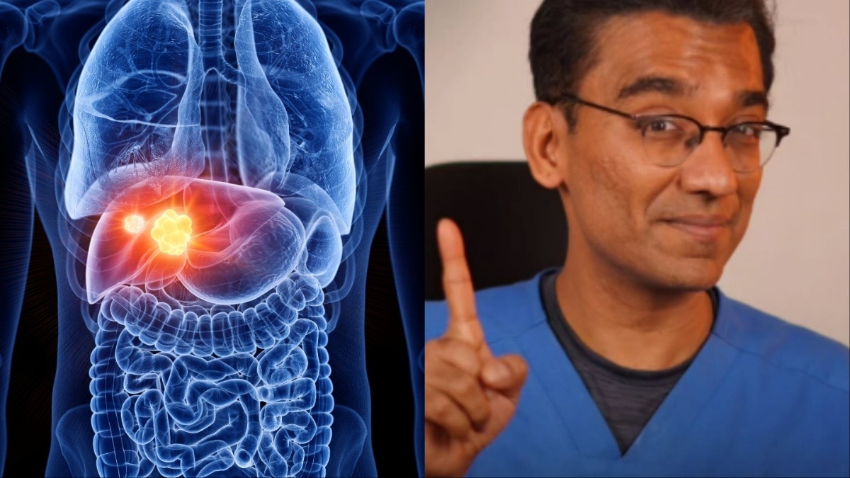 US डॉक्टर ने बताया क्यों शराब न पीने वालों के होते हैं लिवर खराब (Photo- Getty Image & Instagram@/Dr. Pal Manickam)