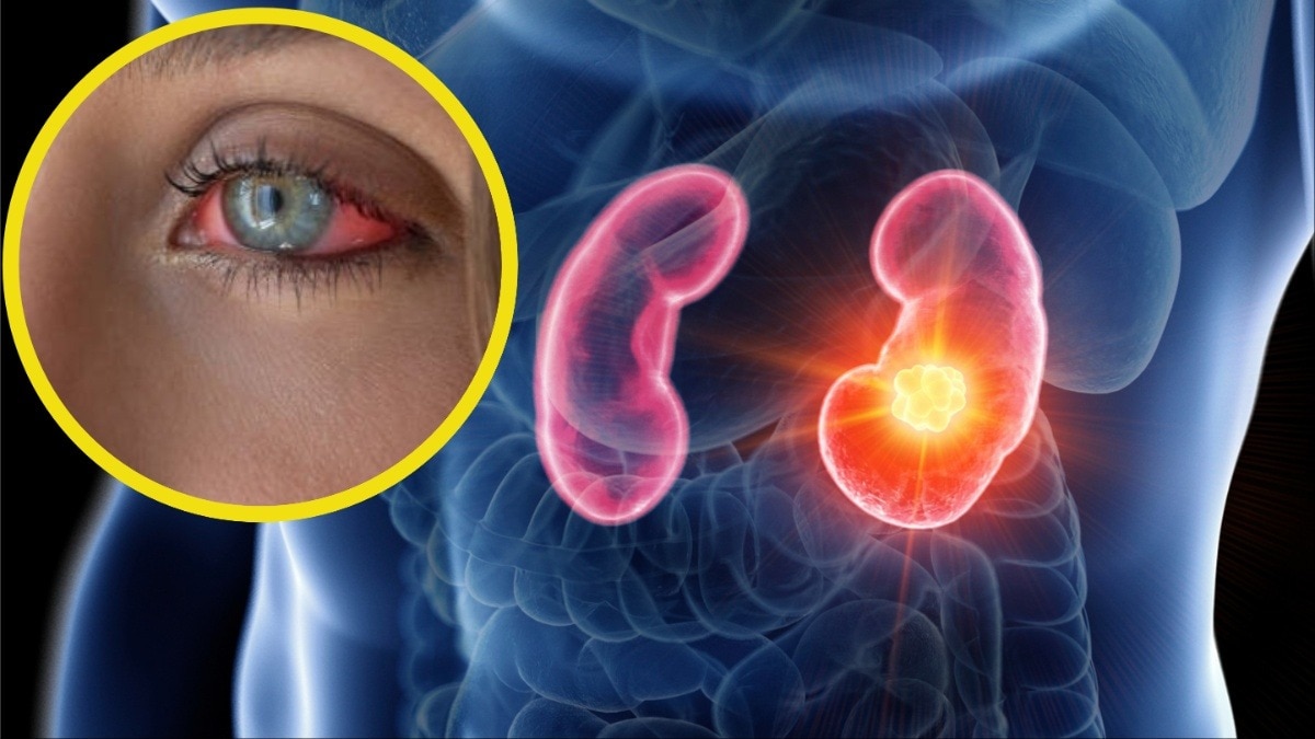 आंखों में दिखते हैं किडनी डैमेज के लक्षण (Photo: Getty)