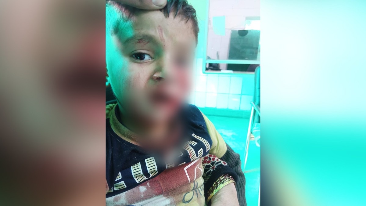 बच्चे को आवारा कुत्ते ने काटा (Photo: Ritik Rajput/ITG)