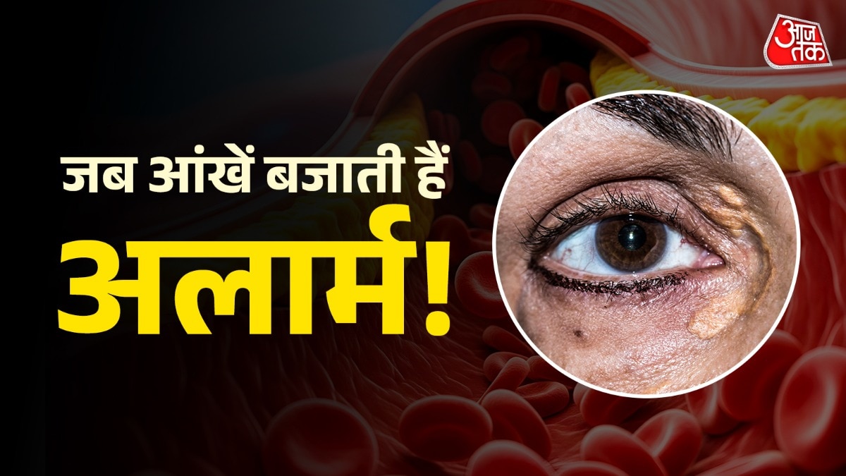 High Cholesterol warning signs in winters (Photo: ITG)