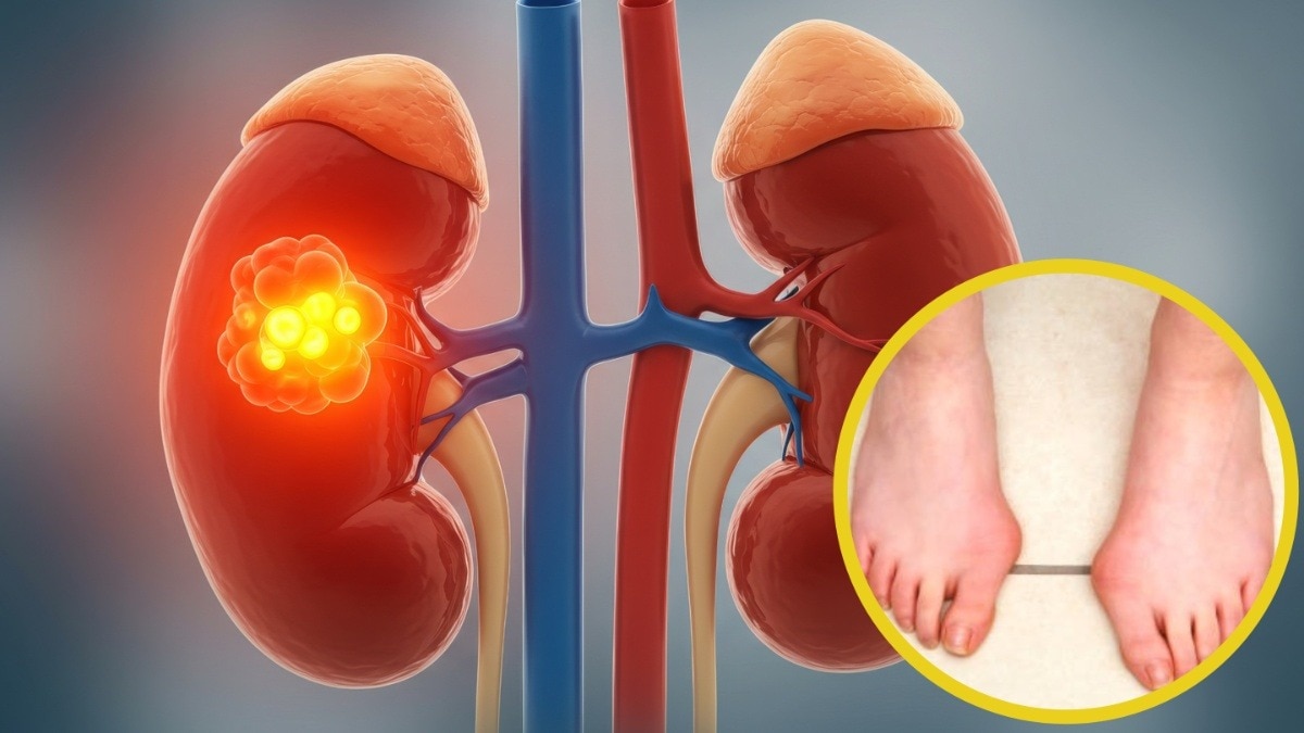Kidney Damage symptoms 