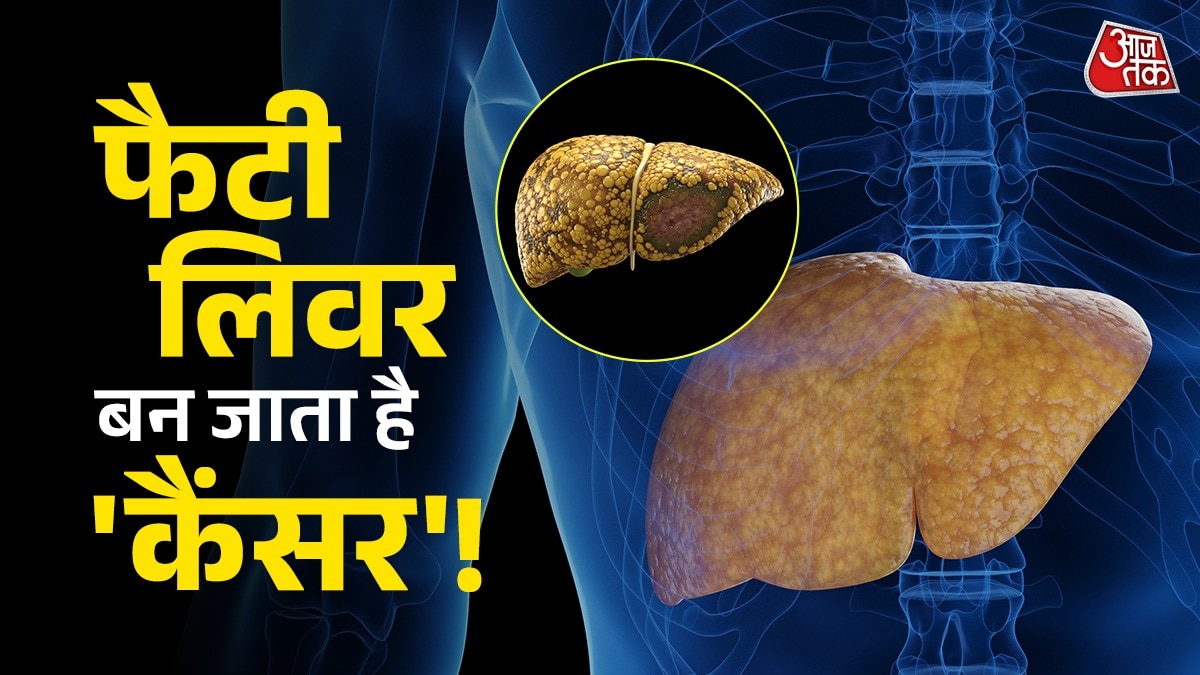 Fatty Liver (Photo: ITG)