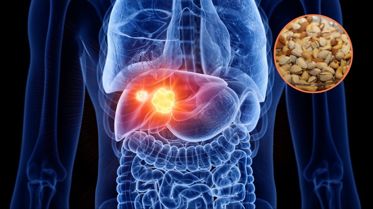 ड्राई फ्रूट्स जो फैटी लिवर को कम करने में मदद कर सकते हैं (Photo- Pixabay & Getty image)