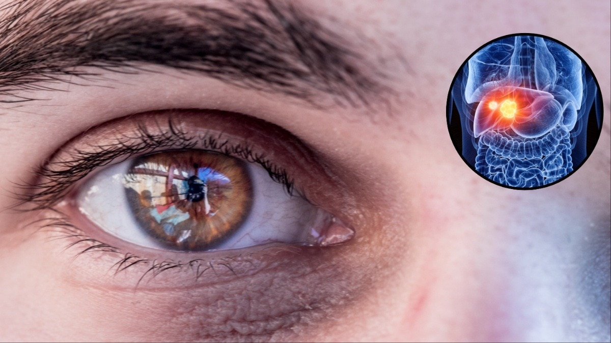 आपके  डार्क सर्कल्स नॉर्मल है या लिवर खराब होने का संकेत! ऐसे पहचानें (Photo- Pixabay)